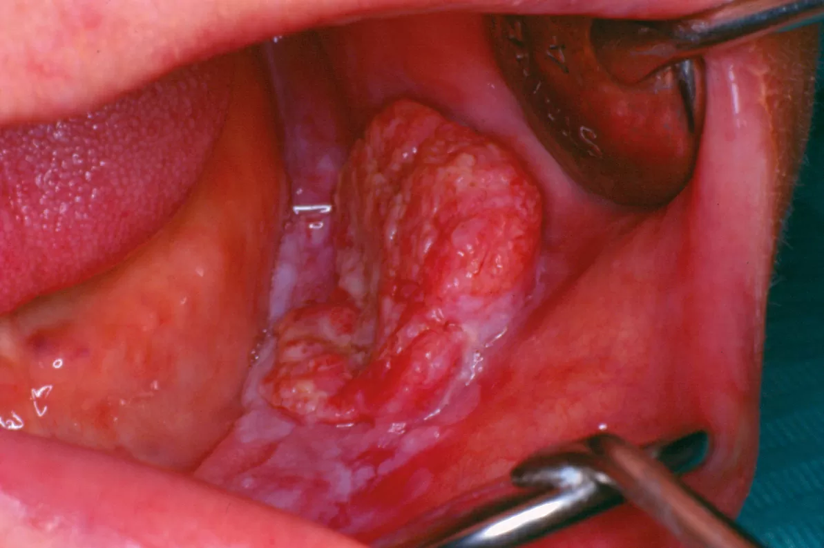 Cancro Oral - foto 4