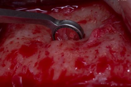 Endodontia: Microcirurgia apical (3º Módulo, Lisboa)