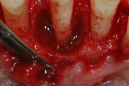 Periodontologia: Tratamento cirúrgico na doença periodontal (2º módulo, Porto)