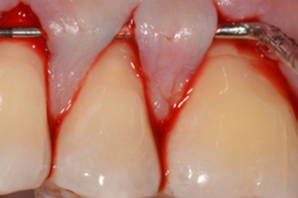 Periodontologia: Cirurgia mucogengival e regenerativa (3º módulo, Porto)