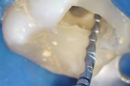 Instrumentação em endodontia (Angra do Heroísmo)