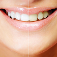 Infarmed desaconselha a compra de produtos para branqueamentos dentários à venda em lojas