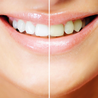 TVI24 entrevistou bastonário sobre branqueamentos dentários