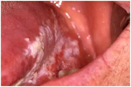 Leucoplasia no bordo da língua e carcinoma do pavimento da boca