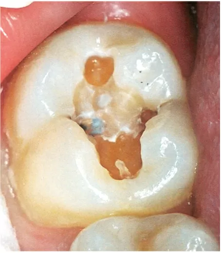 Cavidade cárie no mesmo dente