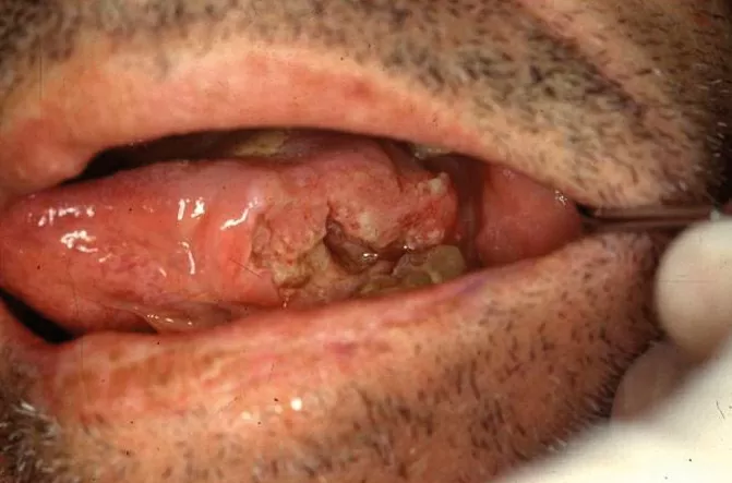 Cancro Oral - foto 3