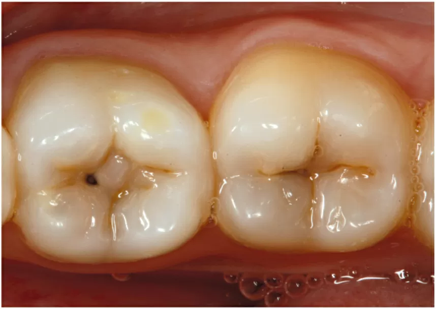 Dente molar da esquerda com uma cárie