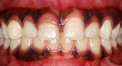 caso-20120206