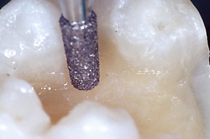 Dentisteria: Preparações dentárias para inlays, onlays e overlays (2º módulo, Porto)