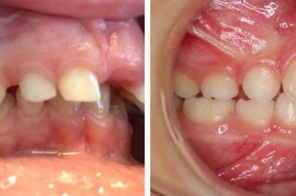 Abordagem ao paciente em odontopediatria / ortodontia inteceptiva - moda ou necessidade?