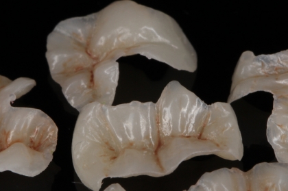 Dentisteria: Restaurações semi-diretas com resinas compostas (3º módulo, Porto)