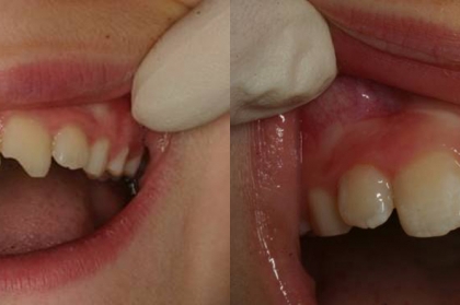 Traumatismos dentários na criança e no adolescente
