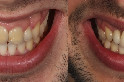 Tratamento de recessões gengivais em dentes e implantes
