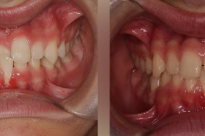 Ortodontia: Tratamento ortodôntico precoce (2º módulo, Porto)