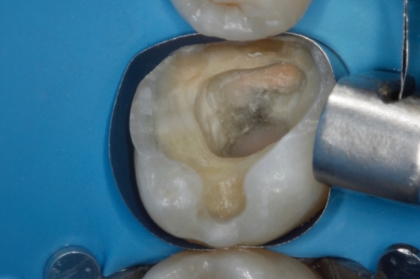 Dentisteria: Elevação de margens profundas (1º módulo, Porto)