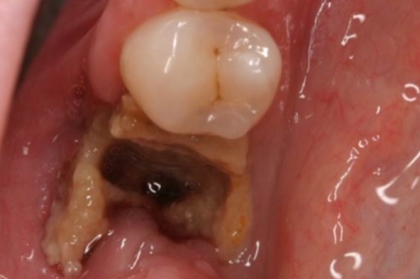Cirurgia oral em pacientes medicamente comprometidos