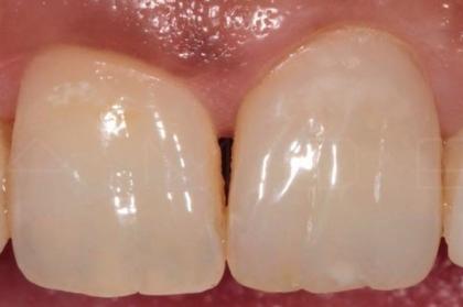 Imitando a natureza com resinas no setor anterior: pontos-chave para o sucesso