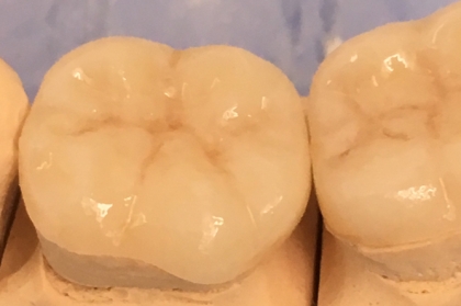 Dentisteria: Restaurações diretas e indiretas em dentes posteriores