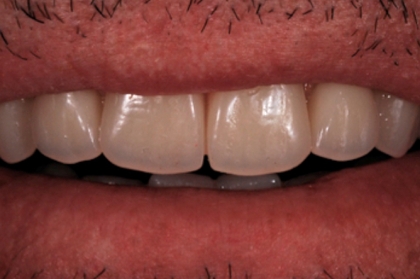 Reabilitação oral: Perspetivas na reabilitação estética oro-facial