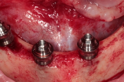 Cirurgia oral: Implante e carga imediata: recomendações clínicas e consensos