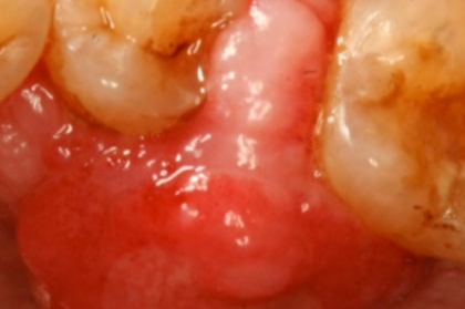 Medicina oral: Biópsias na cavidade oral