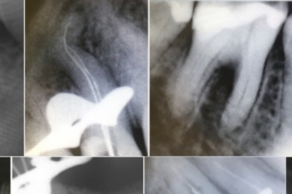 Endodontia: Os sistemas rotativos em endodontia: como escolher?