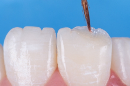 Facetas em resina composta vs facetas em cerâmica: opções terapêuticas (streaming)