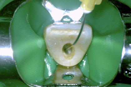 Endodontia: Soluções de irrigação de A a Z
