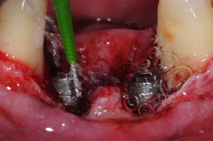 Periodontologia: novos conceitos e sua aplicação clínica