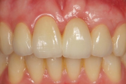 Coroas de revestimento total - novos materiais e técnicas de adesão (streaming)