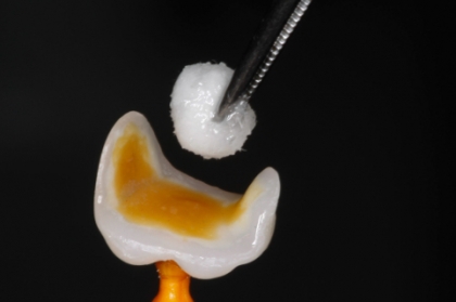 Recobrimento cuspídeo: indicações e técnicas