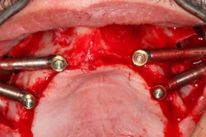 Implantes em setores posteriores - possibilidades de reabilitação (streaming)