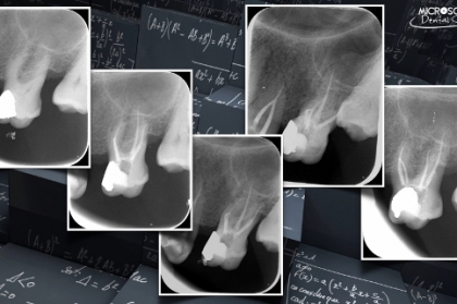 Que sistema de limas usar na prática clínica? Qual a evidência científica? (streaming)
