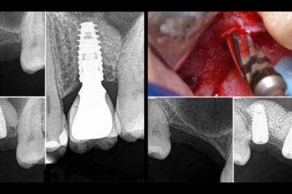 Elevação de seio maxilar por abordagem crestal com osseodensificação