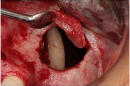 Riscos, complicações e terapêutica na cirurgia oral