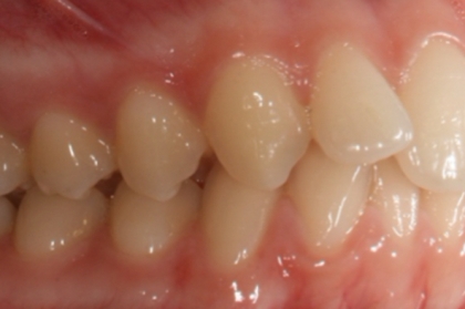 Tratamento ortodôntico de classes II - opções de reabilitação? (streaming)