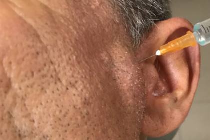 Oclusão: Infiltrações intra-articulares no tratamento da disfunção temporomandibular