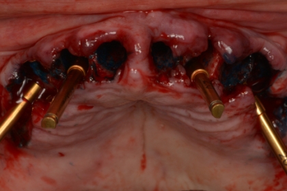 Implantologia: Colocação de implantes em zonas de limitação anatómica