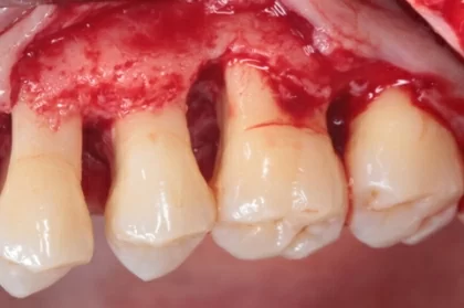 Periodontologia: Tratamento cirúrgico (ressetivo vs regenerativo) (2º módulo, Lisboa)