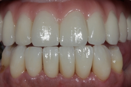 Dentisteria: Facetas dentárias com recurso ao sistema CAD-CAM