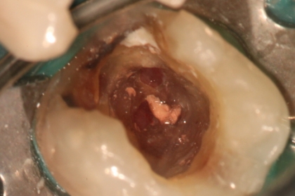 Lesões endo-perio: do diagnóstico à abordagem clínica