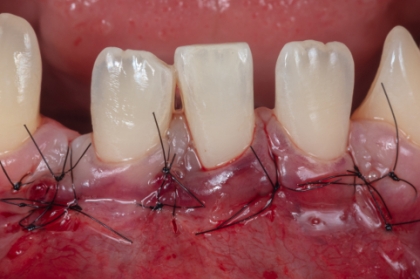 Periodontologia: Cirurgia plástica periodontal (3º módulo, Lisboa)