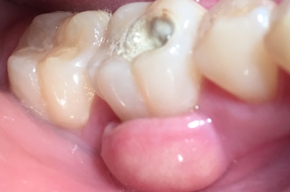 Urgências e diagnóstico em endodontia