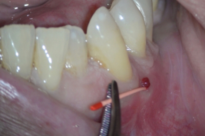 Endodontia: Diagnóstico e urgências em endodontia (1º módulo, Porto)