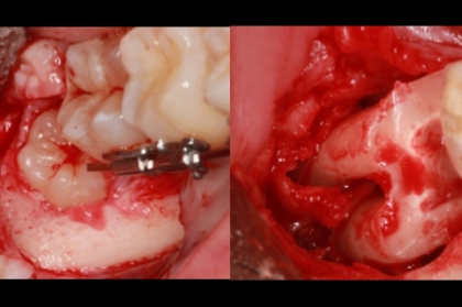 Abordagem clínica da exodontia dos terceiros molares inclusos
