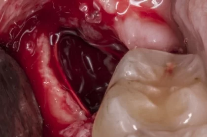 Cirurgia oral: Terceiros molares inclusos - indicações e procedimentos cirúrgicos