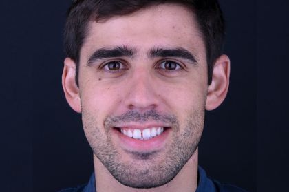 Disfunção temporomandibular: etiologia e diagnóstico