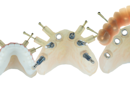 Novas tecnologias em implantologia oral - tendências atuais