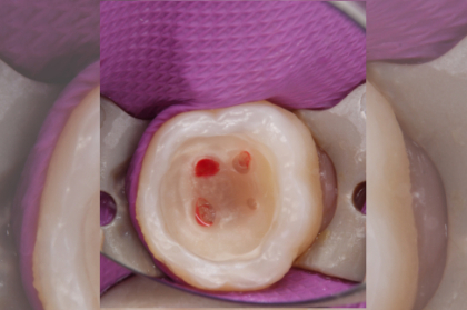 Terapia pulpar vital - dicas clínicas