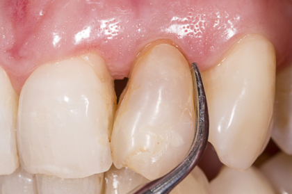 Implantologia: Manutenção de dentes e prótese implanto-suportadas (3º módulo, streaming)